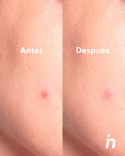 Cargar imagen en el visor de la galería, Parches para Granos, uso de noche - Nipskin®
