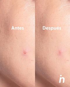 Parches para Granos, uso de día - Nipskin®
